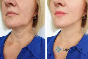 Double chin before and after Hi-Fu treatment 4 Book your double chin treatment Billingshurst today! We are here to help!