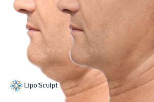 Double chin before and after Hi-Fu treatment 2 Double chin treatment Billingshurst from Lipo Sculpt - feel more confident today!