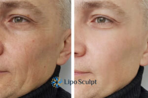 How to Fight Aging Symptoms 3 Fight Aging Symptoms Billingshurst With HIFU and Morpheus8 Today!