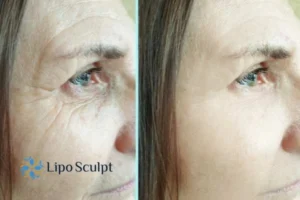 How to Fight Aging Symptoms 2 Do you want to Fight Aging Symptoms Billingshurst? Contact Lipo Sculpt today!