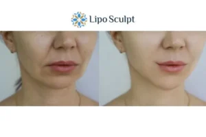 Explaining Total Skin Tightening Treatment And What It Can Do For You 2 Do you want to boost your self confidence? Give Morpheus8 Billingshurst a try today!