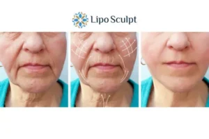 Explaining Total Skin Tightening Treatment And What It Can Do For You 3 Boost your confidence with Morpheus8 Billingshurst call our team today!