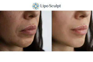 Explaining Total Skin Tightening Treatment And What It Can Do For You 4 Morpheus8 Billingshurst the best results - call our team today!