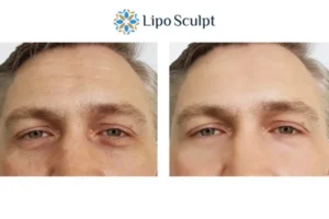 Explaining Total Skin Tightening Treatment And What It Can Do For You 6 Morpheus8 Billingshurst book in today to find out more!