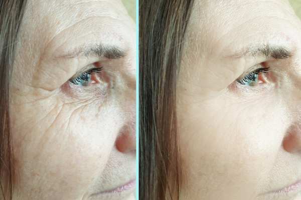Why Do People Choose HIFU for a Non-Surgical Facelift? 4 How long can HIFU results last Billingshurst?