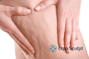 CoolSculpting for Legs: The Innovative Approach to Redefining Your Legs 5 Start your journey today book your coolsculpting treatment Billingshurst online today!