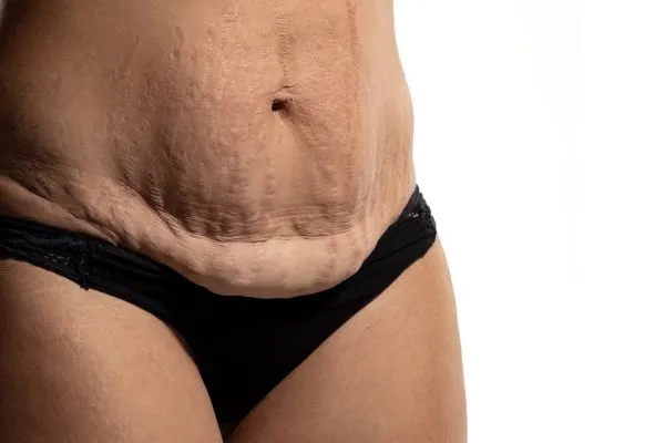 Lost the Weight but Not the Loose Skin? 1 image of womans stomach after weight loss showing loose skin Billingshurst